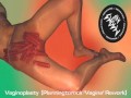 Vaginoplasty